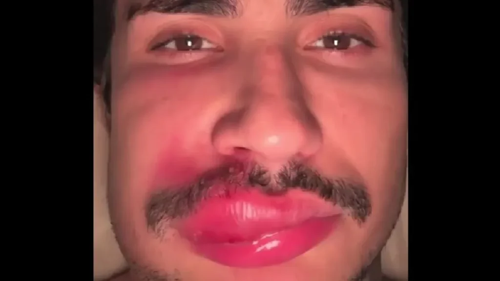 Influenciador quase morre após espremer espinha